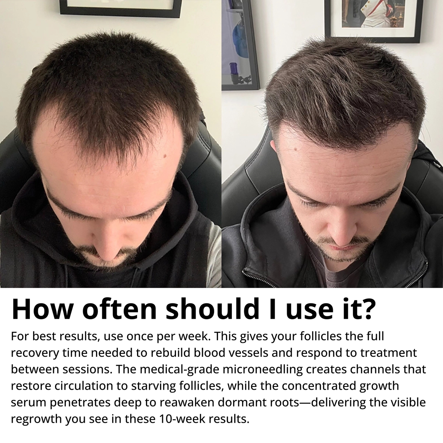 Myrix Follicle Awakening System™