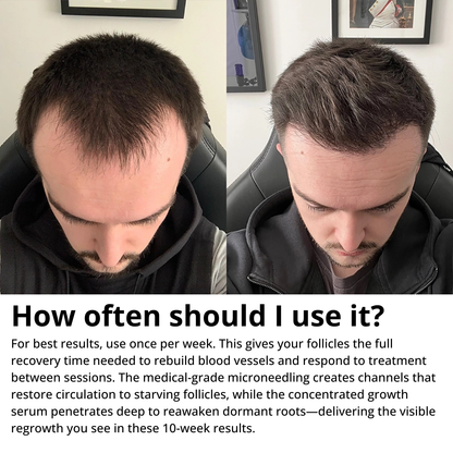 Myrix Follicle Awakening System™