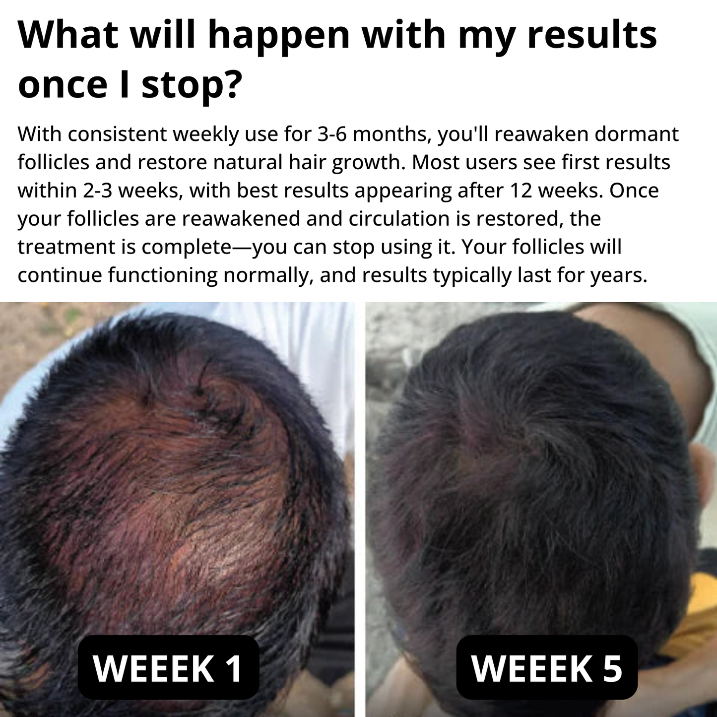 Myrix Follicle Awakening System™