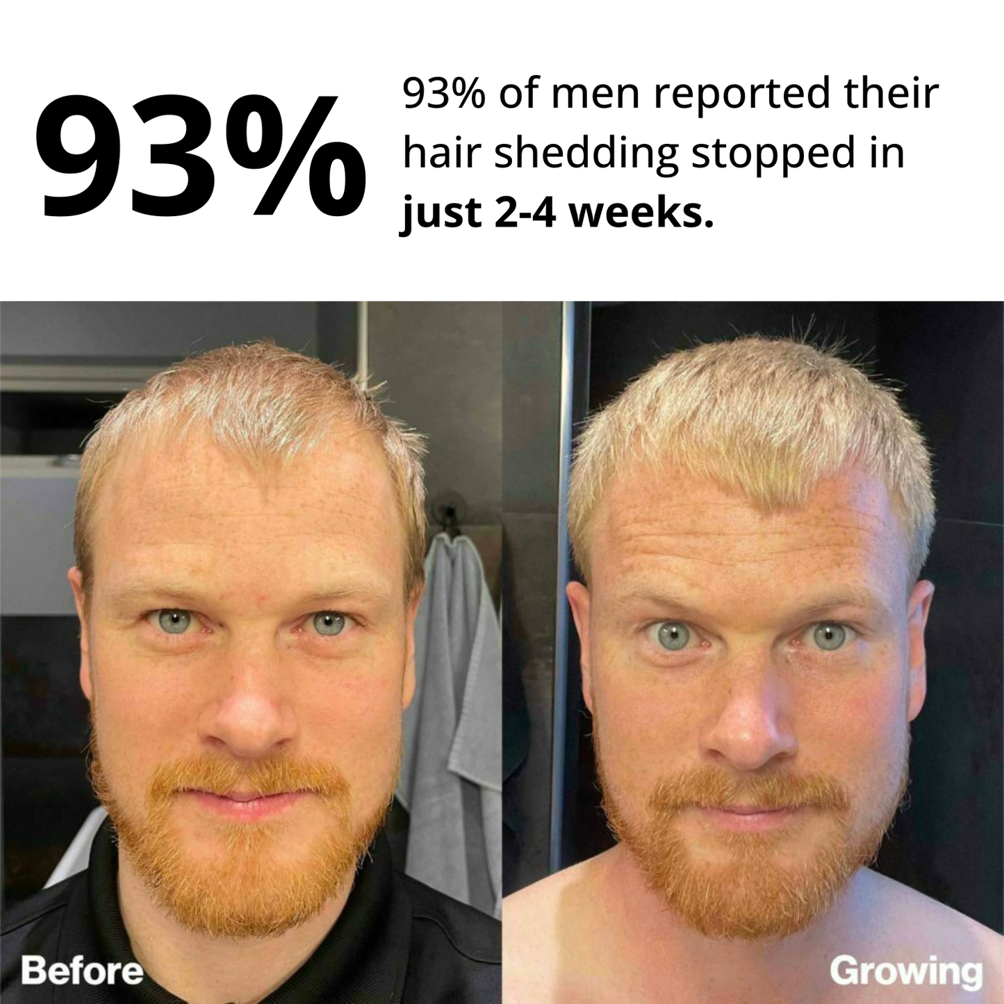 Myrix Follicle Awakening System™